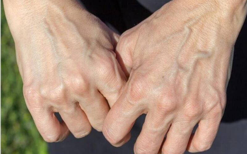 لماذا تظهر عروق بعض الناس من الجلد وتختفي عن آخرين
